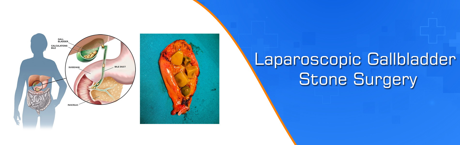 Laparoscopic Gallbladder Stone Surgery In kuchaman city nagaur