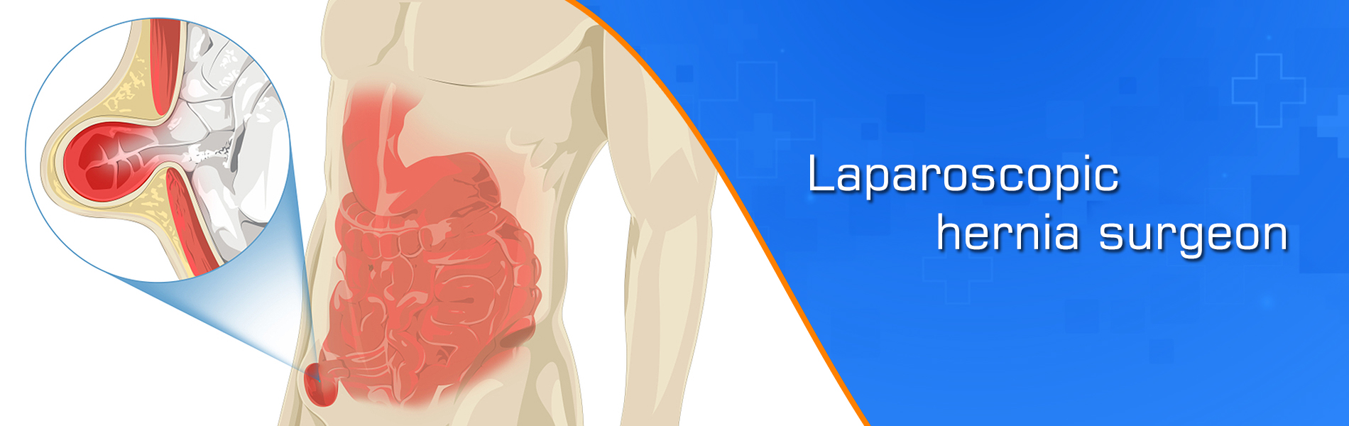 Laparoscopic hernia surgeon in Jaipur